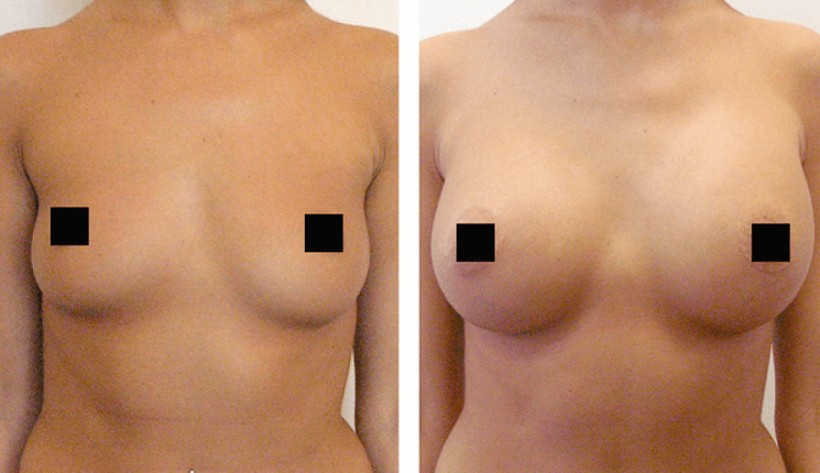 Brust vor und nach der Vergrößerung mit Hyaluronsäure