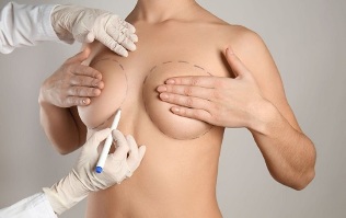 Brustvergrößerungsmethoden mit Operation