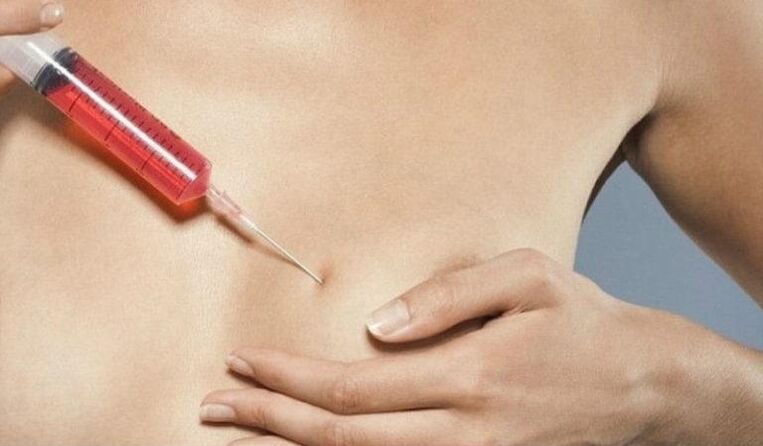 Brustvergrößerung mit Hyaluronsäure-Injektionen