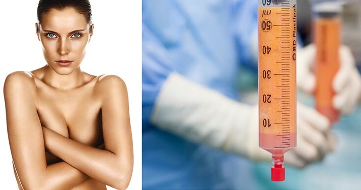 Lipofilling als Methode zur Brustvergrößerung